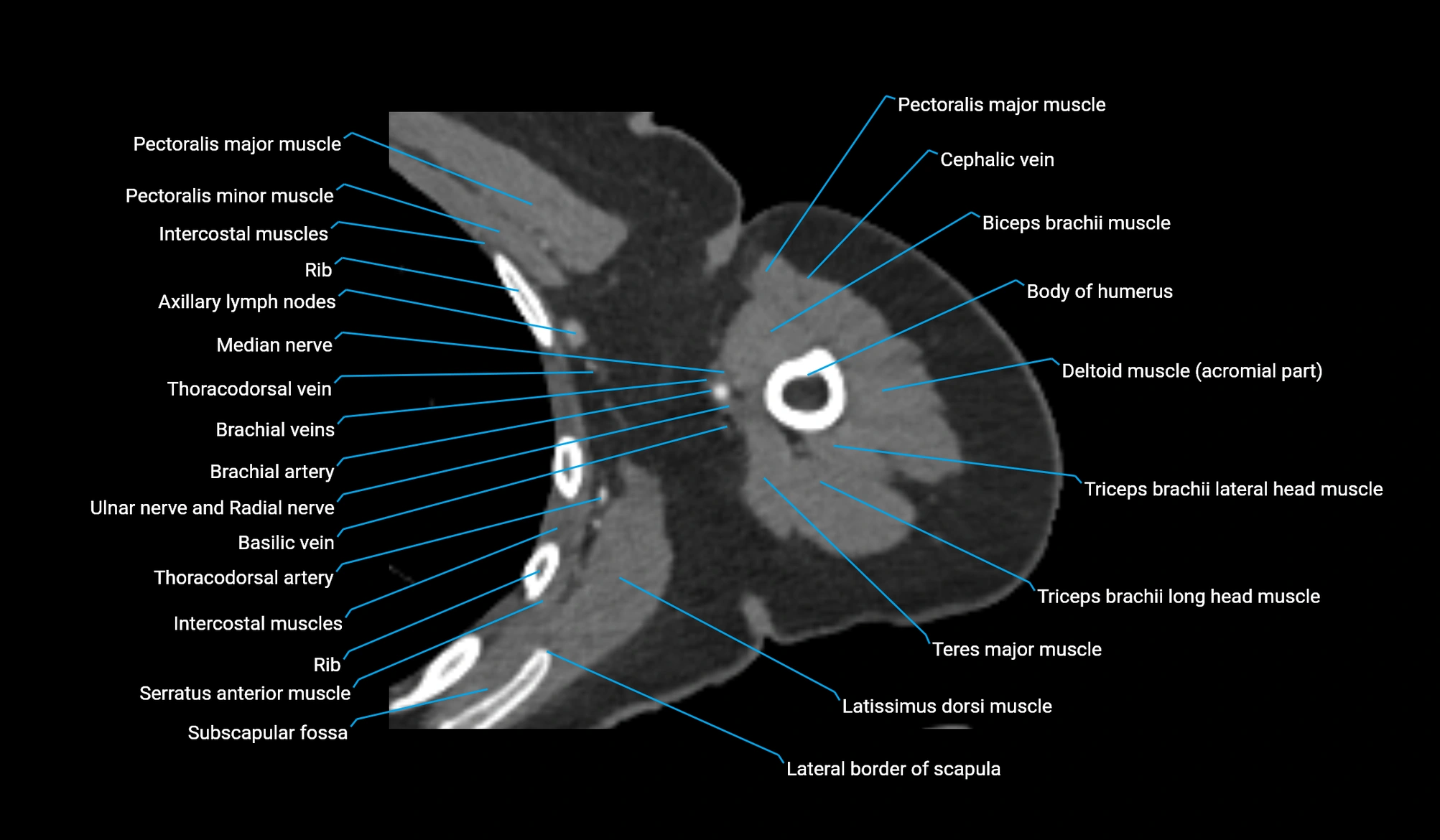 CT upper arm axial  cross sectional anatomy labelled radiology image -00166.webp
